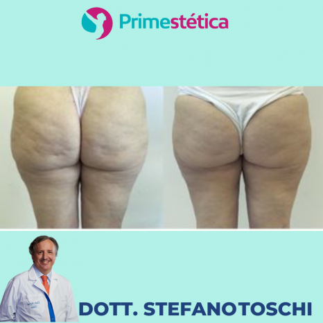 Liposuzione  Dr Stefano Toschi