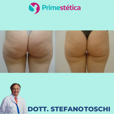 Liposuzione  Dr Stefano Toschi