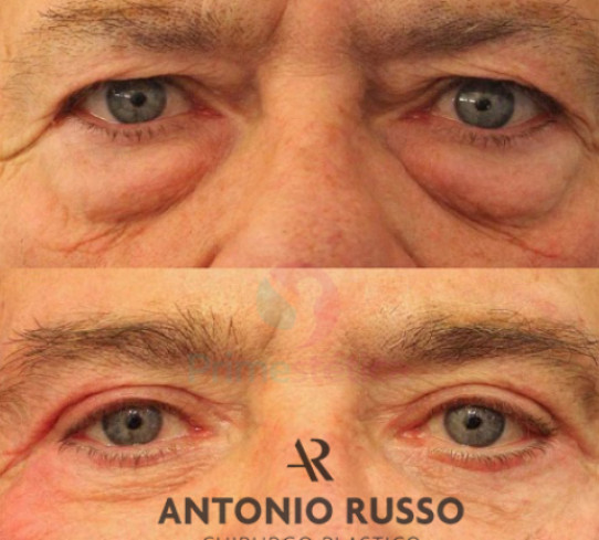 Blefaroplastica Dr Antonio Russo