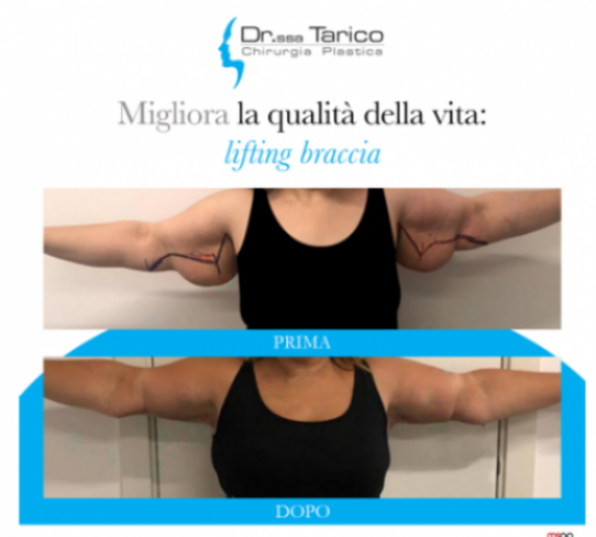 Lifting braccia Dott.ssa Tarico