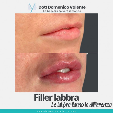 Filler labbra Dott. Domenico Valente