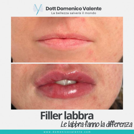 Filler labbra Dott. Domenico Valente