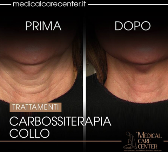 Carbossiterapia Dott.ssa Alessia Canonaco