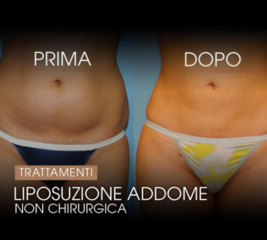 Liposuzione  NON CHIRURGICA Dott.ssa Alessia Canonaco