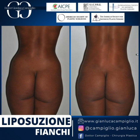 liposuzione dott. Gianluca Campiglio