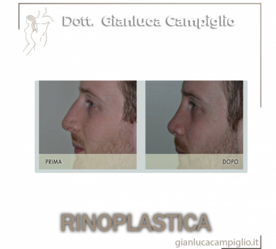 Rinoplastica Milano  Dott. Gianluca Campiglio