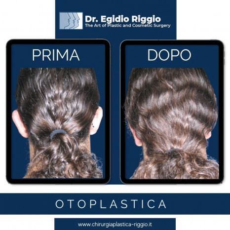 Dott. Egidio Riggio, Otoplastica prima e dopo