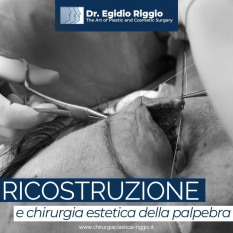 Dott. egidio Riggio - Ricostruzione estetica della palpebra